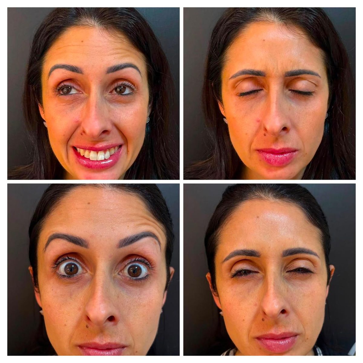 Toxina botulínica (Botox) — linhas de expressão, antes e depois