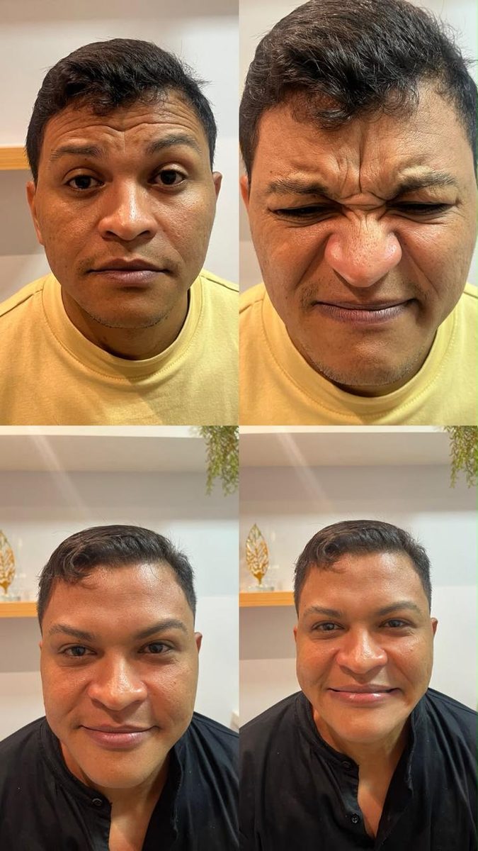 Toxina botulínica (Botox) em paciente homem — antes e depois