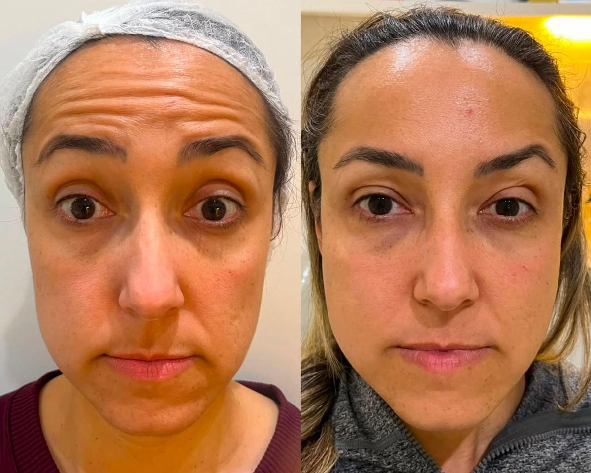Toxina botulínica (Botox) — testa e glabela, antes e depois