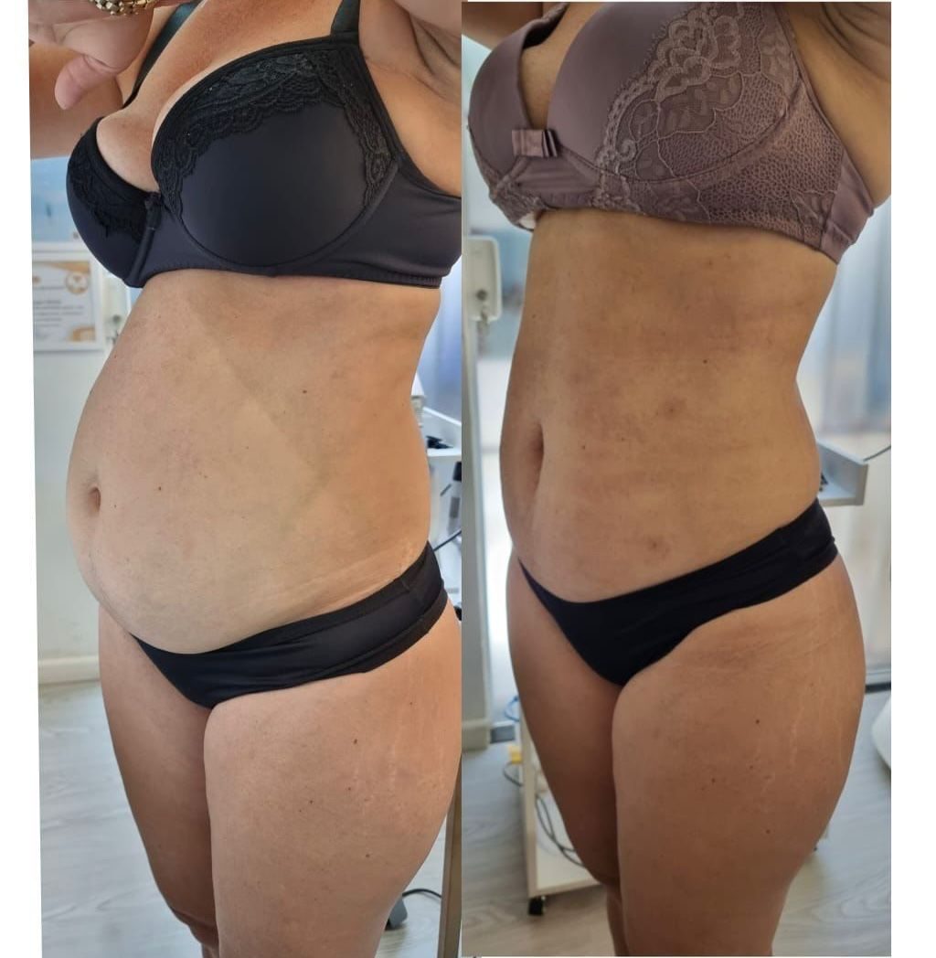 Endolaser — contorno abdominal, antes e depois