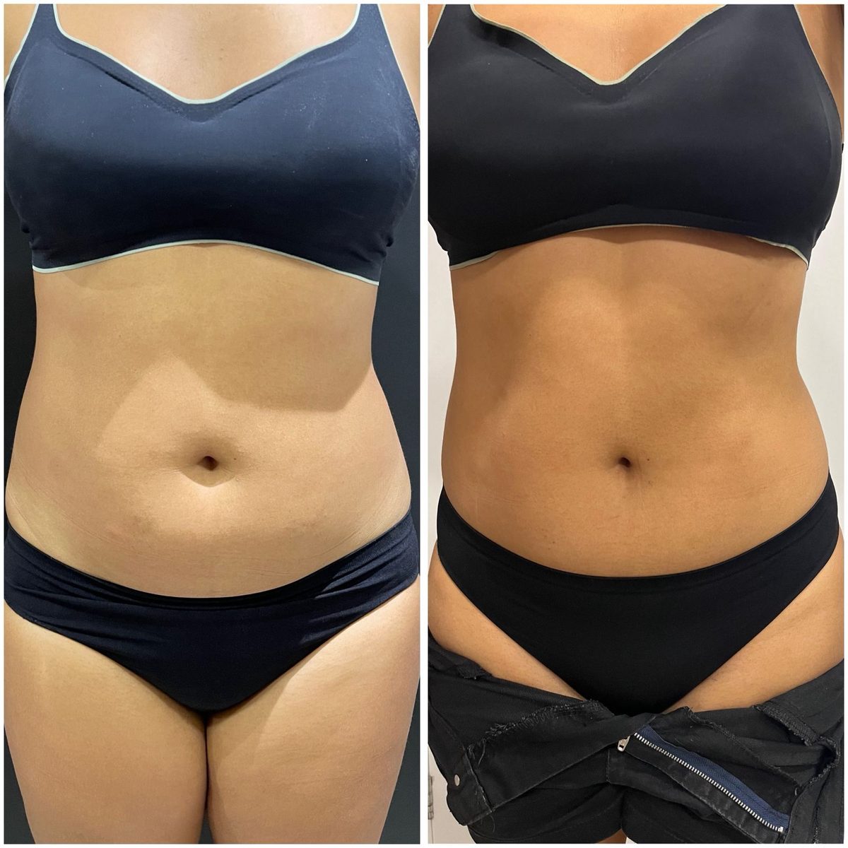 Antes e depois de Endolaser no abdômen