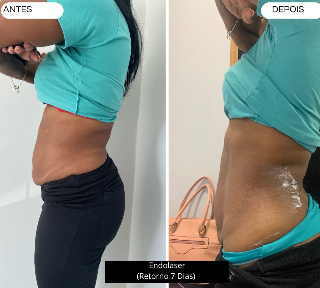 Endolaser — abdômen, retorno em 7 dias
