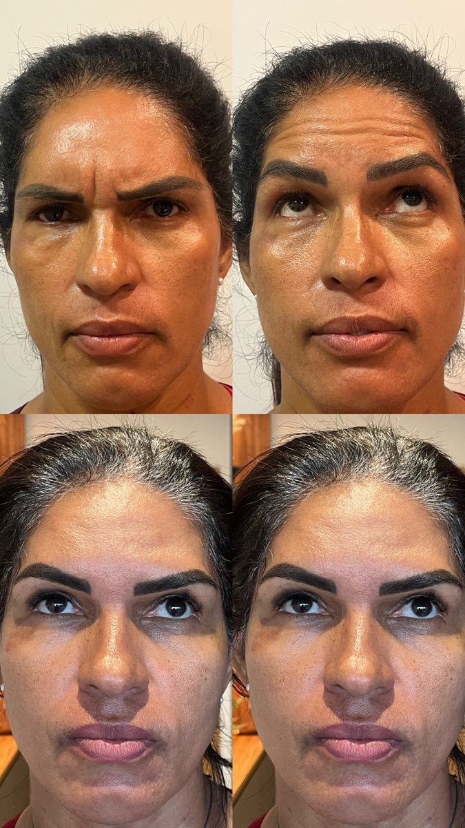 Fios de sustentação com toxina botulínica — antes e depois