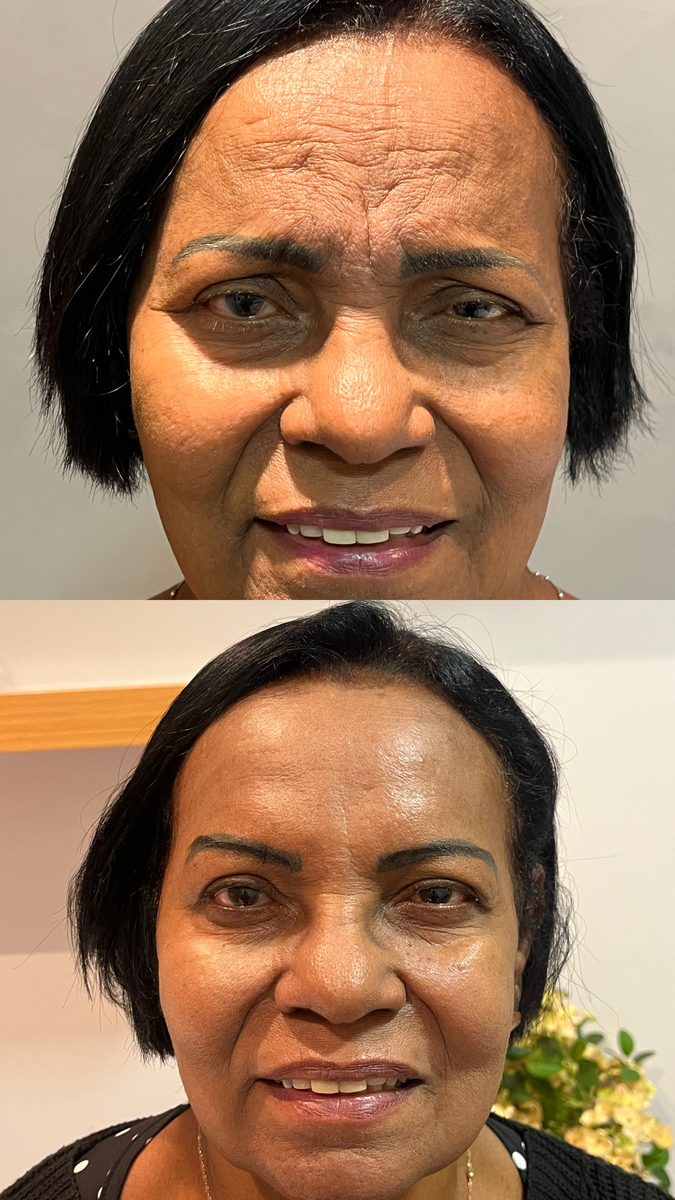 Fios de sustentação com toxina botulínica — antes e depois