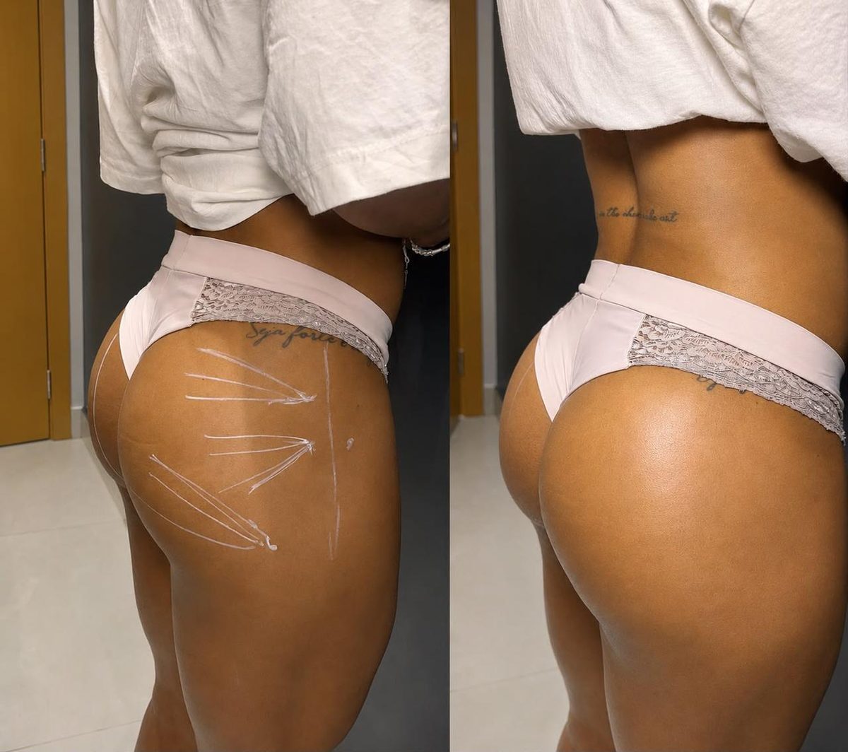 Harmonização glútea — contorno e projeção, antes e depois