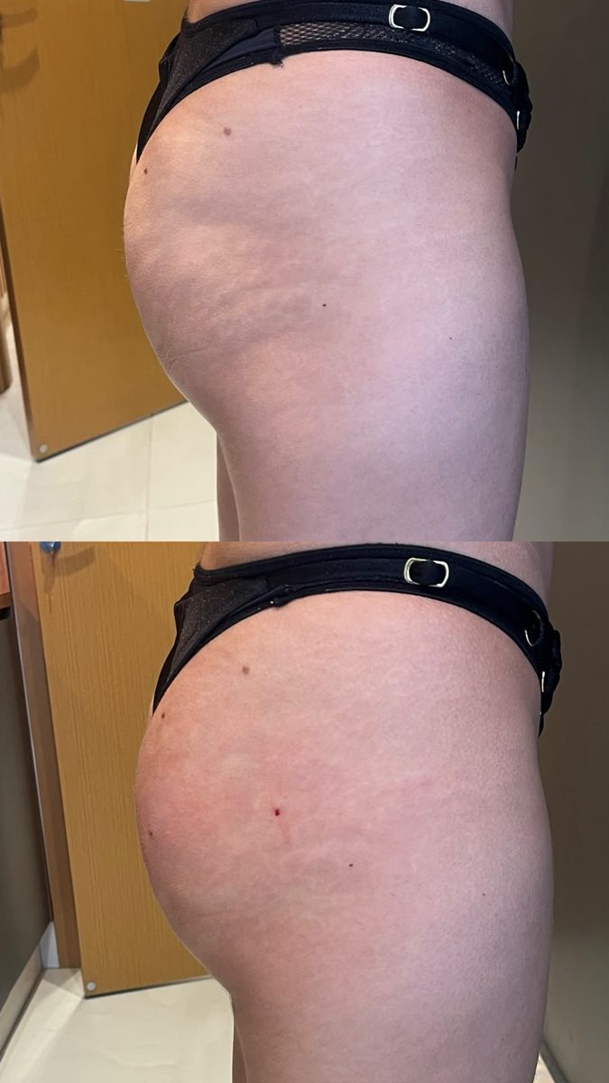 Antes e depois de harmonização glútea (Perfect Glúteo)