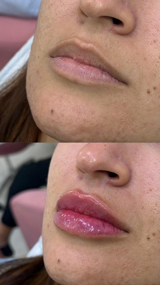 Preenchimento labial — antes e depois
