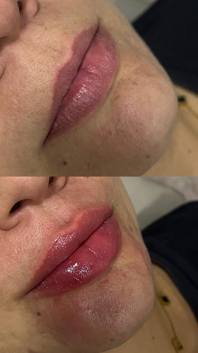 Preenchimento labial — contorno e volume, antes e depois