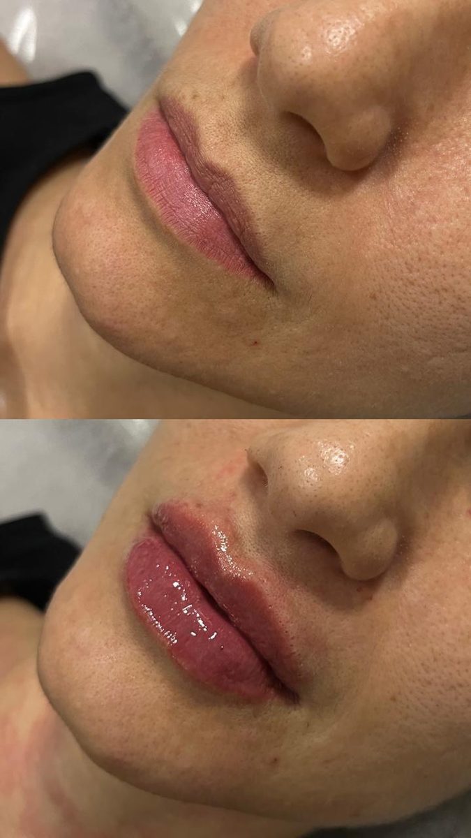 Preenchimento labial — antes e depois