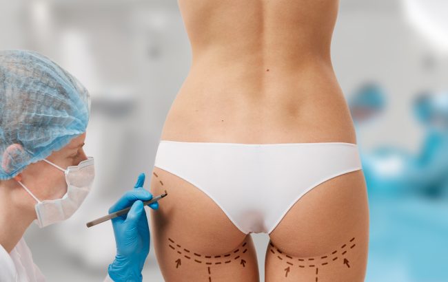 Drawing lines on a Caucasian woman's abdomen as marks for abdominal cellulite cosmetic correction surgery. Operation in the background